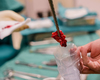 Une biopsie liquide associée à l’IA pour distinguer fibrome et léiomyosarcome avant chirurgie