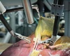 Un robot chirurgical autonome réalise avec succès une opération complexe de la vésicule biliaire