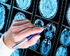 Focale corticale dysplasie type II negatief op MRI: nieuwe nuttige gegevens