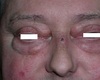Klinische casus: een ‘oedeem’ van de oogleden met een onverwachte oorzaak