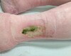 Votre plus belle image: Pseudomonas aeruginosa, pas de vert dans les plaies chroniques
