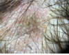 Dermoscopie: Quand les cheveux s’affolent