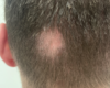 Cas clinique: Nodules alopéciants aseptiques du cuir chevelu