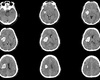 Nut van mini-invasieve chirurgie bij spontane intracerebrale bloeding: de MIND-studie