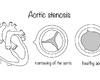 Un TAVI précoce est-il indiqué dans la sténose aortique en l’absence de symptômes?