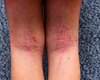 Artsen en patiënten willen meer bekendheid geven aan huidziekte atopische dermatitis
