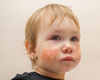 Un granulome facial aseptique idiopathique atypique