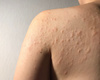 Een klinisch overzicht van contacturticaria