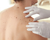 Solidaris: meer screening op huidkanker, maar wachtlijsten bij dermatoloog zijn probleem