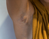 Hidradenitis suppurativa bij kinderen en adolescenten