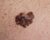 Près de 46.000 nouveaux cancers de la peau chaque année en Belgique, selon Euromelanoma