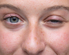 OMGRate-q, een gedeeltelijk gevalideerde vragenlijst voor zelfevaluatie van de symptomen van oculaire myasthenia gravis