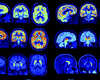 Wereldprimeur voor UZ Leuven: PET-scanner helpt hersenziekten vroegtijdig opsporen 