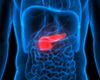 Cancer du pancréas: près de 50% de nouveaux diagnostics supplémentaires attendus d'ici 2035