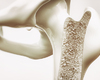 Ostéoporose : huit femmes sur dix ne sont pas traitées après une première fracture