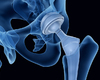 Prothèses de la hanche :   6 recommandations de bonne pratique et 11 points d’amélioration (Audit)