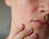 Kwaliteit van de huid definiëren voor betere behandeling