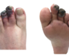 Klinische casus: black toes
