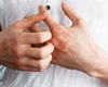 Dermatite atopique: une atteinte de la qualité de vie