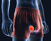 Lymphome testiculaire primitif: des chiffres sur ses caractéristiques cliniques et son pronostic