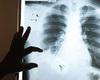 Genezingspercentage tuberculose in België ligt stuk lager dan wereldwijde gemiddelde