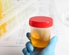 Un nouveau test de méthylation de l’ADN urinaire pour le diagnostic du cancer de la vessie