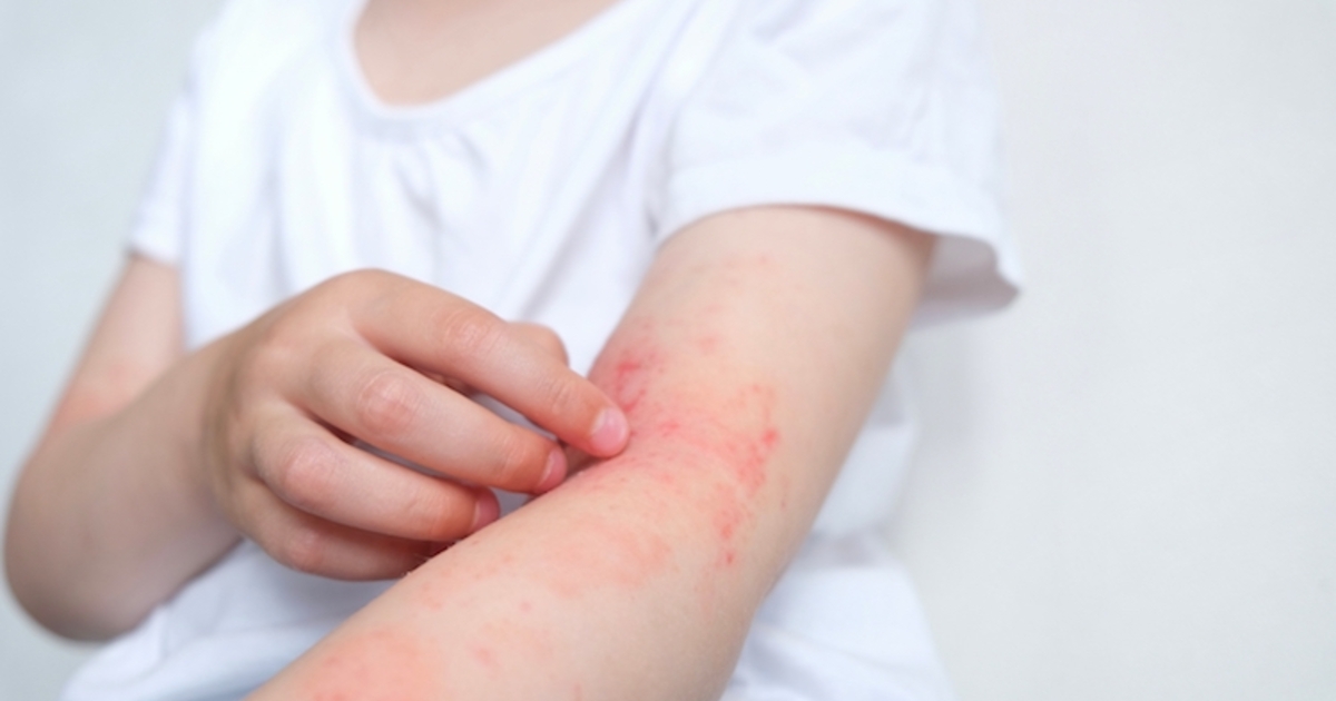 Sphere Excema Dermatite atopique: une pathologie difficile à prendre en charge ...