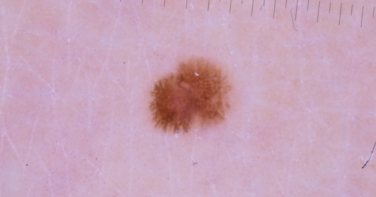 Dermoscopy, the sequel - Skin