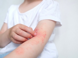 Le lien entre l'eczéma atopique et d'autres affections allergiques identifié