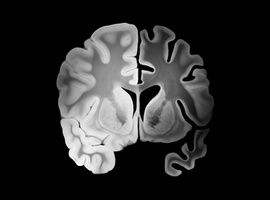 Visceraal vet zou een beïnvloedbare factor zijn bij cognitieve achteruitgang