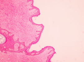 Mammoleaks: pleidooi voor geïndividualiseerde borstkankerscreening (Drs Fabienne Liebens (Isala Brussel) & Pino Cusumano (CHU Luik)