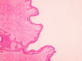 Camizestrant als eerstelijnsbehandeling bij gevorderde borstkanker met ESR1-mutatie