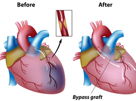 Pontage aortocoronarien: mieux vaut un DAPT que l’aspirine seule pour la prévention de la défaillance du greffon saphène