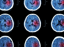 Effect van suppletie met korteketenvetzuren op het herstel na een cerebrovasculair accident