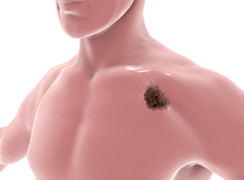 Systemic therapy for unresectable/metastatic cutaneous melanoma: ASCO guideline
