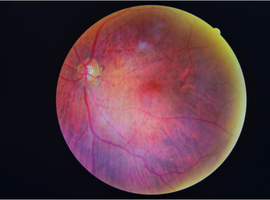 Verergert een snelle daling van het HbA1c-gehalte de diabetische retinopathie bij type 2-diabetes?