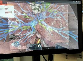 Wereldprimeur: longkankeroperatie met augmented-realitytechnologie