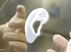 Un chirurgien a greffé un implant d'oreille imprimé à partir de cellules humaines