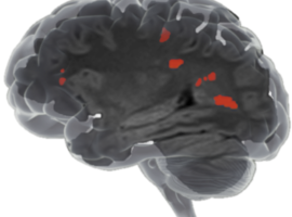 Icometrix  lève 18 millions de dollars pour Icobrain, sa solution d'IA en imagerie médicale