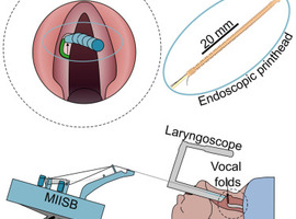 Une micro-imprimante 3D pour reconstruire les cordes vocales pendant la chirurgie