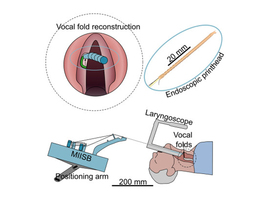 Une micro-imprimante 3D pour reconstruire les cordes vocales pendant la chirurgie