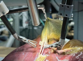 Un robot chirurgical autonome réalise avec succès une opération complexe de la vésicule biliaire