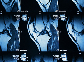 Une IA belge aide à diagnostiquer l’arthrite à partir d’images IRM