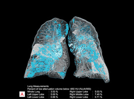 Siemens Healthineers geeft radiologen intelligente digitale assistent