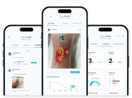 TwinSkin, l'innovation belge qui modélise les plaies en 3D