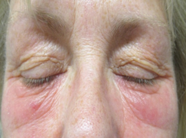 Quand l’eczéma touche les paupières (1e partie)