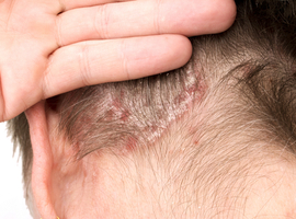 Actualisation du Guide européen (EuroGuiDerm) sur l’eczéma atopique: un résumé