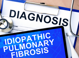 Volgens een mendeliaanse randomisatie zou gastro-oesofageale reflux idiopathische longfibrose kunnen veroorzaken, maar niet omgekeerd