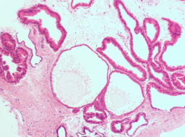 Probiotica en de longen: wat weten we  over mucoviscidose?