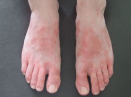 Dermatoses allergiques du sportif: l’équipement souvent en cause